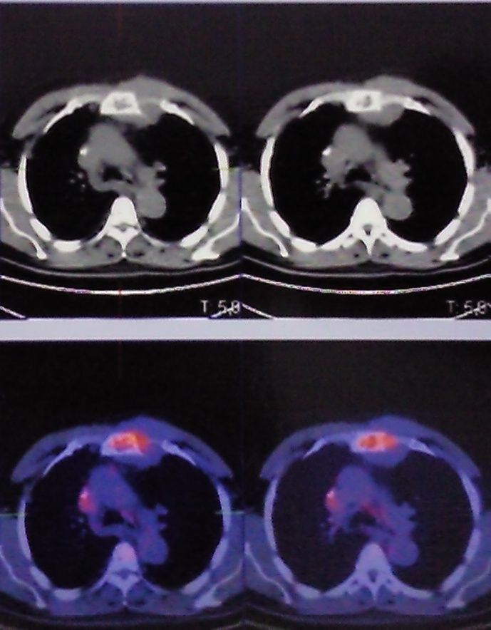 Plasmocitoma esternal. Imagen PET-TAC